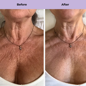 Neck Lift Starter Kit